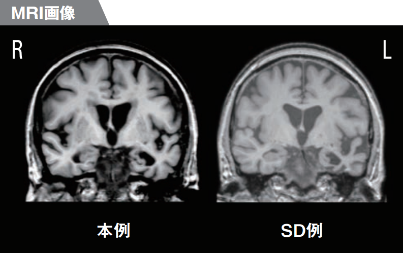 MRI画像