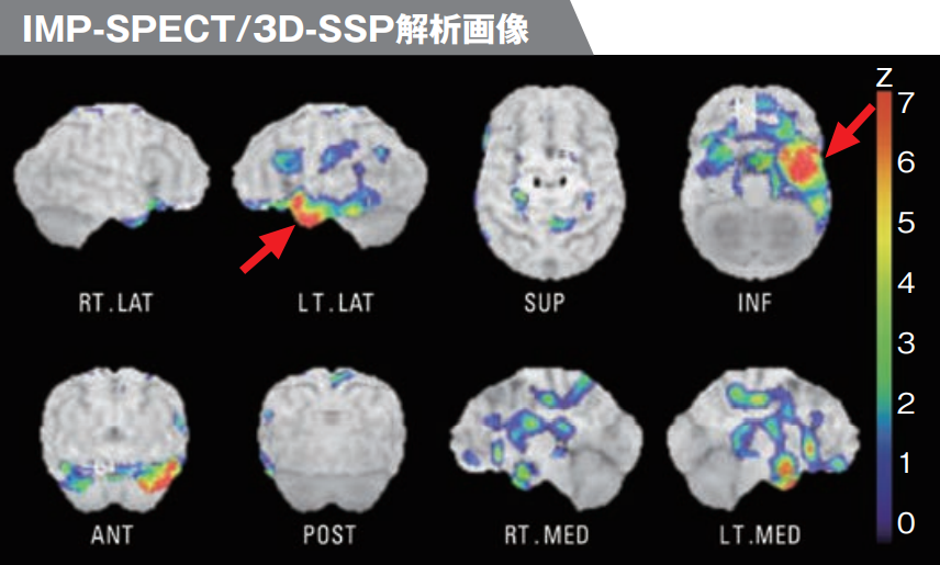 IMP-SPECT/3D-SSP解析画像L