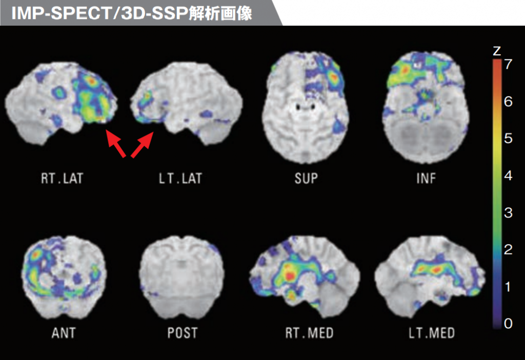 IMP-SPECT/3D-SSP解析画像