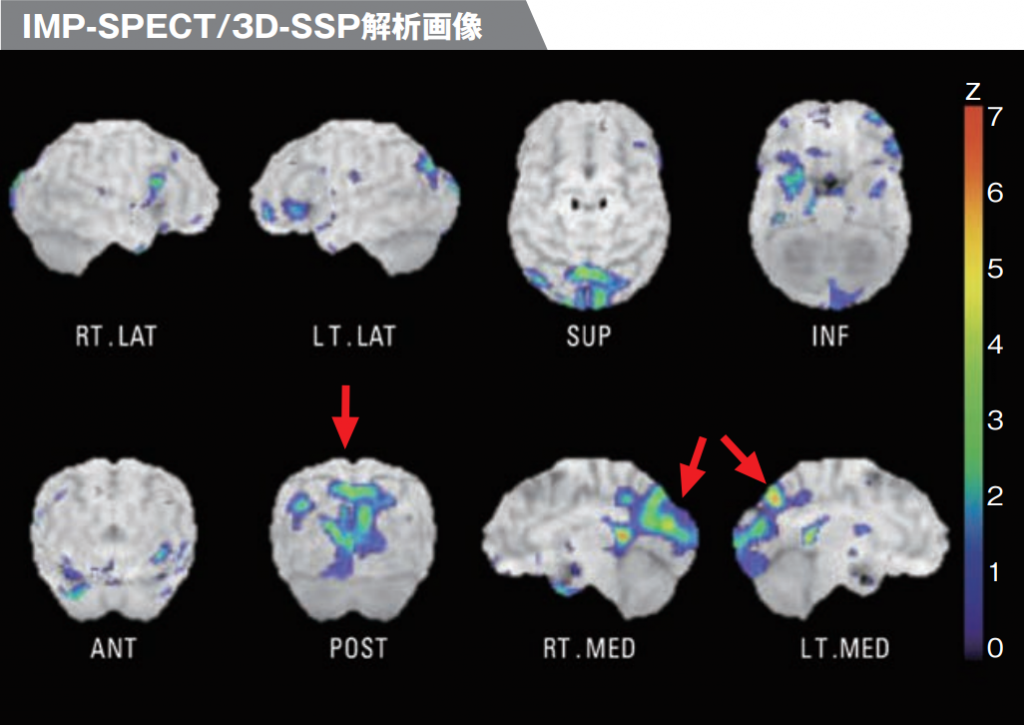 IMP-SPECT/3D-SSP解析画像