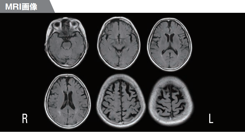 MRI画像