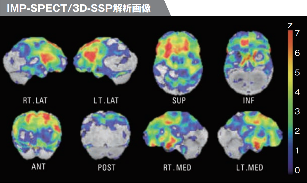 IMP-SPECT_3D-SSP解析画像