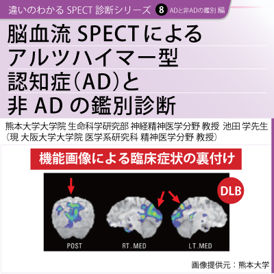 違いのわかるSPECT診断シリーズ 8　ADと非ADの鑑別 編