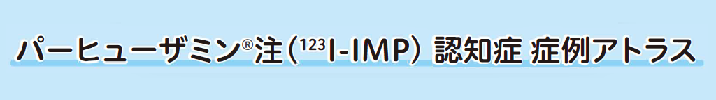 認知症の原因と脳血流SPECT検査について