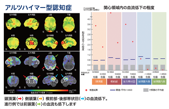 脳血流SPECT検査におけるZ-Graphの解析結果