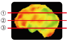 脳血流SPECT画像