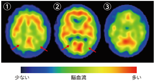 脳血流SPECT断層画像