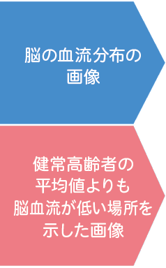 脳の血流分布の画像/健常高齢者の平均値よりも脳血流が低い場所を示した画像