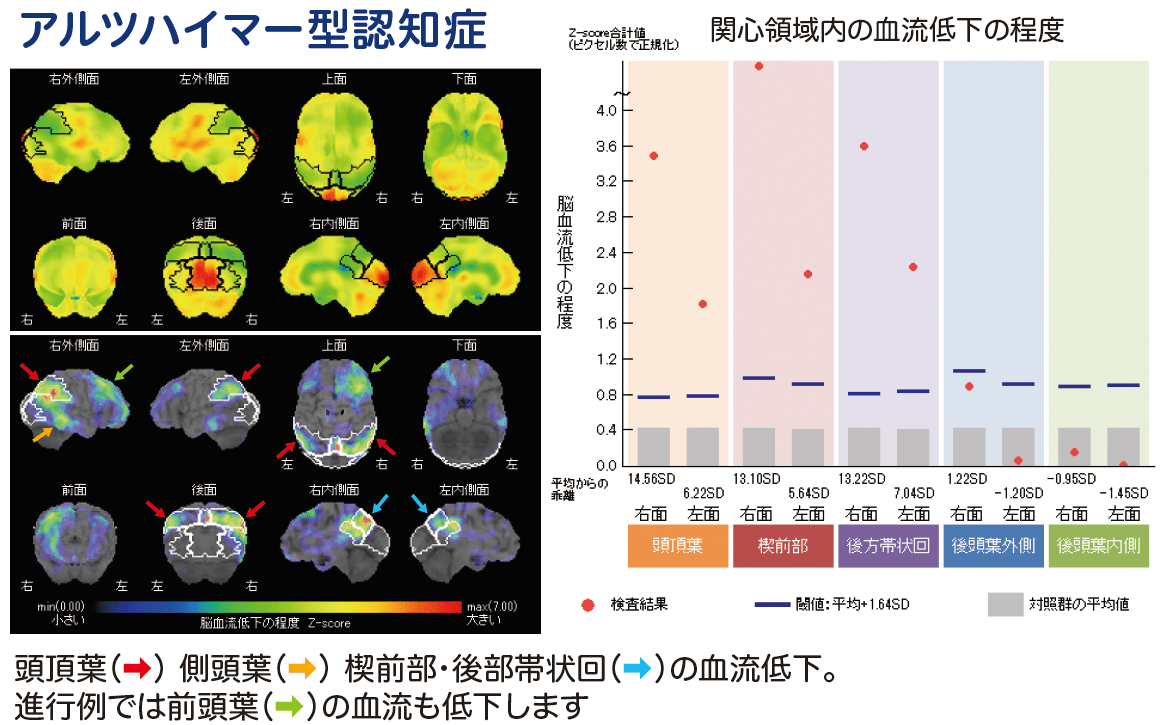 アルツハイマー型認知症　SPECT画像