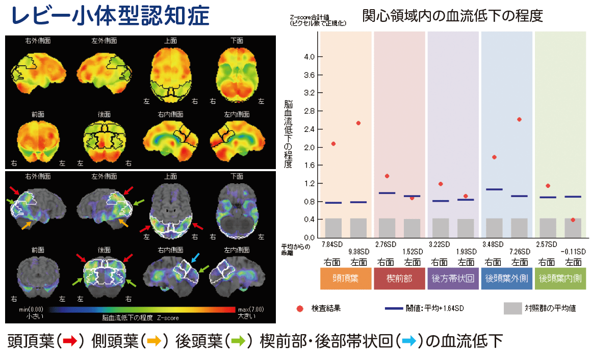 レビー小体型認知症 SPECT画像