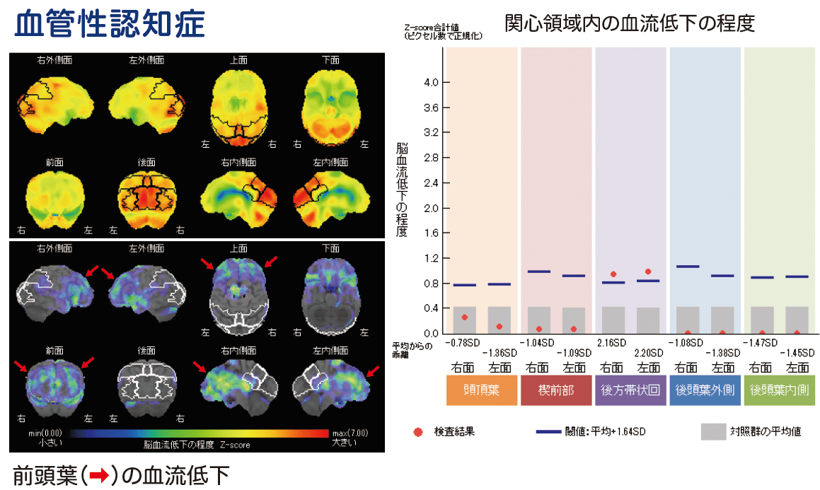 血管性認知症 SPECT画像