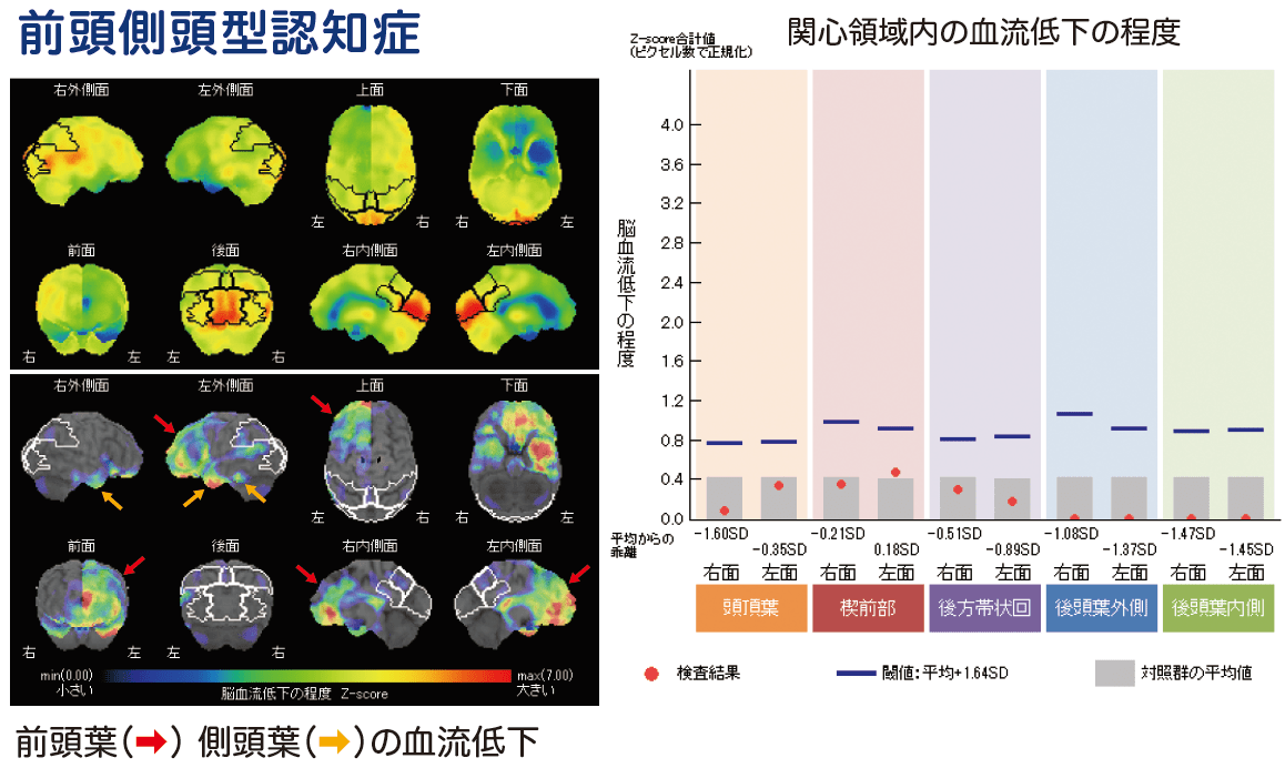 前頭側頭型認知症 SPECT画像