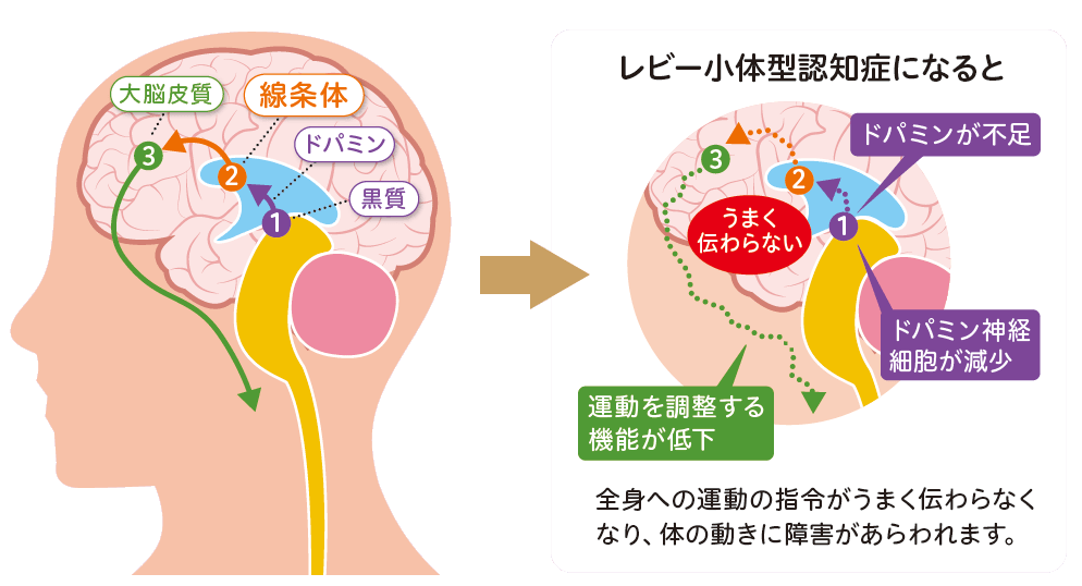 レビー小体型認知症になると？説明イラスト