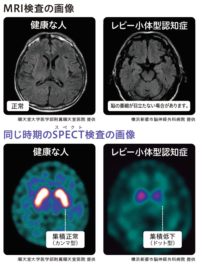 MRI検査の画像と同じ時期のSPECT検査の画像