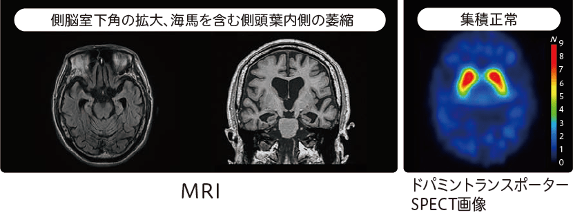アルツハイマー型認知症(AD)のMRI、ドパミントランスポーターSPECT画像