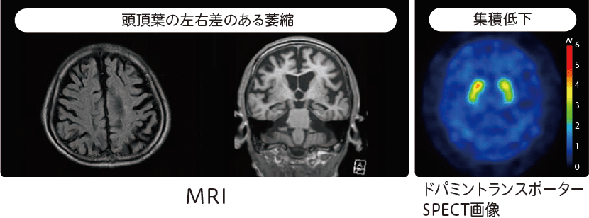 大脳皮質基底核症候群のMRI、ドパミントランスポーターSPECT画像