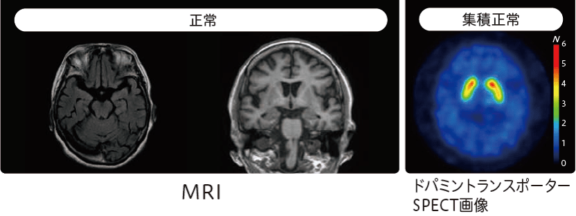 シャルル・ボネ症候群のMRI、ドパミントランスポーターSPECT画像