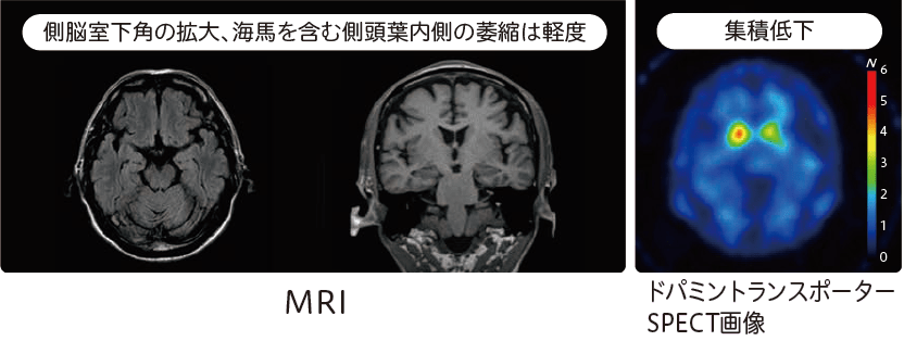 レビー小体型認知症(DLB)のMRI、ドパミントランスポーターSPECT画像