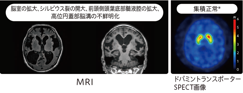 特発性正常圧水頭症(iNPH)のMRI、ドパミントランスポーターSPECT画像