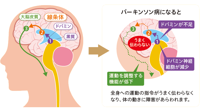 パーキンソン病になると？説明イラスト