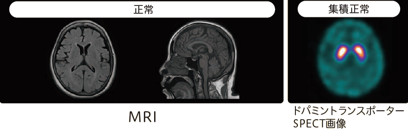 薬剤性パーキンソニズム(DIP)のMRI、ドパミントランスポーターSPECT画像