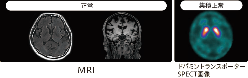 本態性振戦(ET)のMRI、ドパミントランスポーターSPECT画像