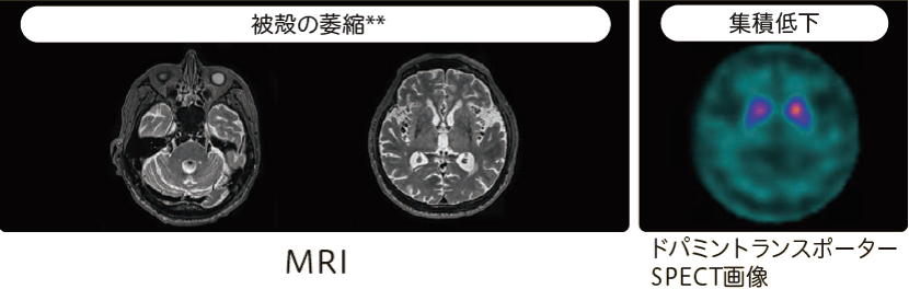 多系統萎縮症(MSA)のMRI、ドパミントランスポーターSPECT画像