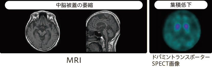 進行性核上性麻痺(PSP)のMRI、ドパミントランスポーターSPECT画像