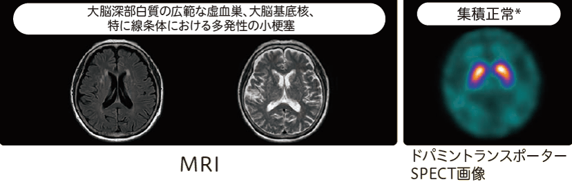 脳血管性パーキンソニズム(VP)のMRI、ドパミントランスポーターSPECT画像