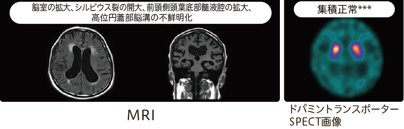特発性正常圧水頭症(iNPH)のMRI、ドパミントランスポーターSPECT画像