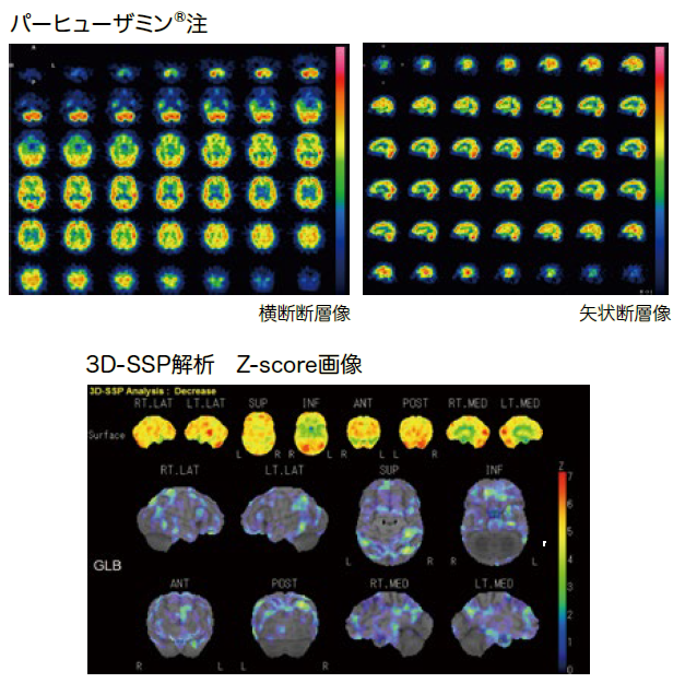 パーヒューザミン注スペクト画像。横断断層像、矢状断層像、3D-SSP解析　Z-score画像