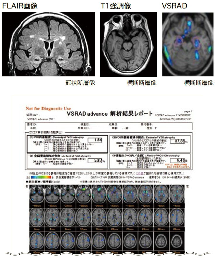 FLAIR画像、T1強調像、VSRAD、VSRADadvance 解析結果レポート