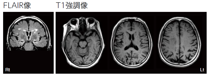 FLAIR像、T1強調像