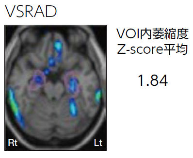 VSRAD VOI萎縮度　Z-score平均1.84