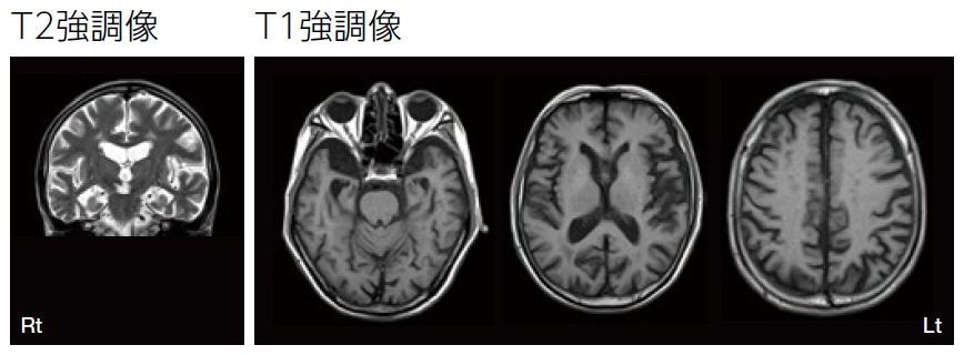 T2強調像、T1強調像