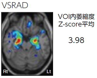 VSRAD VOI内萎縮度　Zscore平均3.98