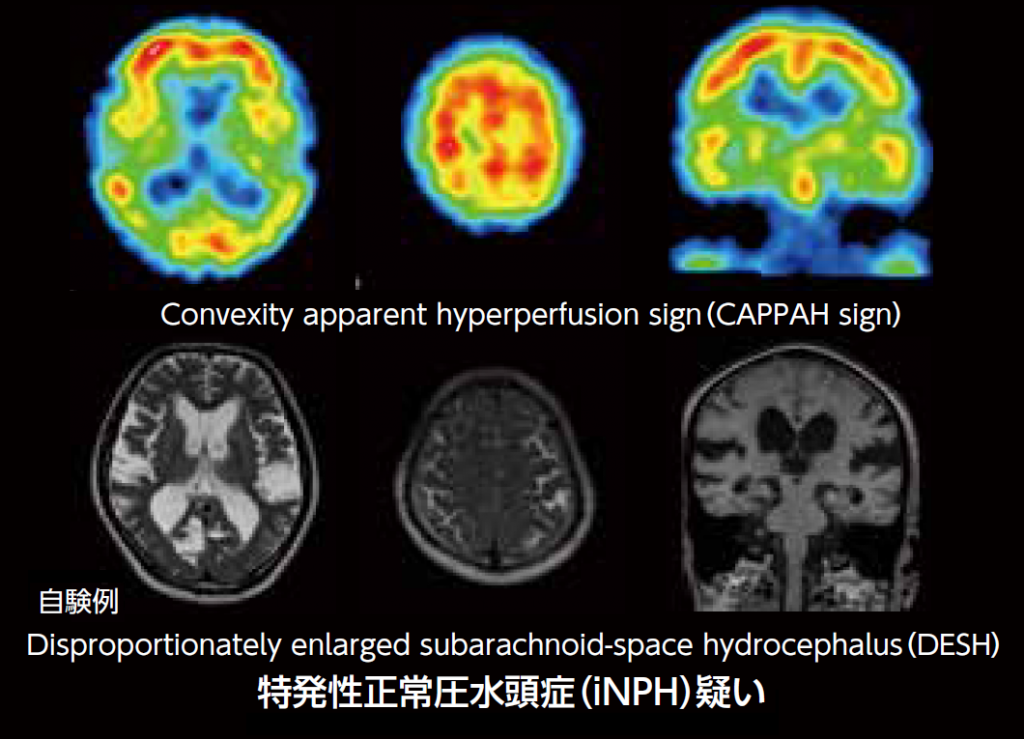123I-IMP脳血流SPECT/MRI画像