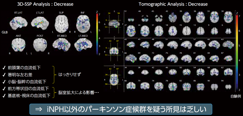 123I-IMP脳血流SPECT 3D-SSP画像