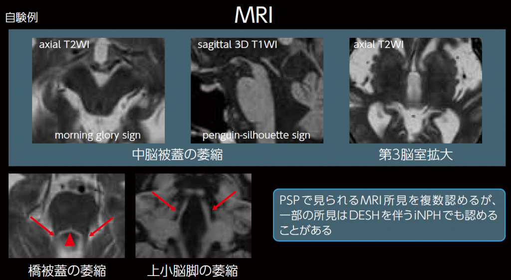 自験例MRI画像