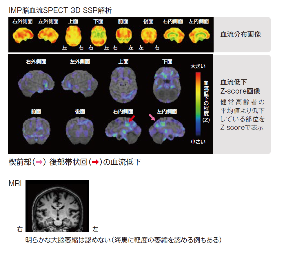 健忘型軽度認知障害画像　IMP脳血流SPECT 3D-SSP解析　MRI画像