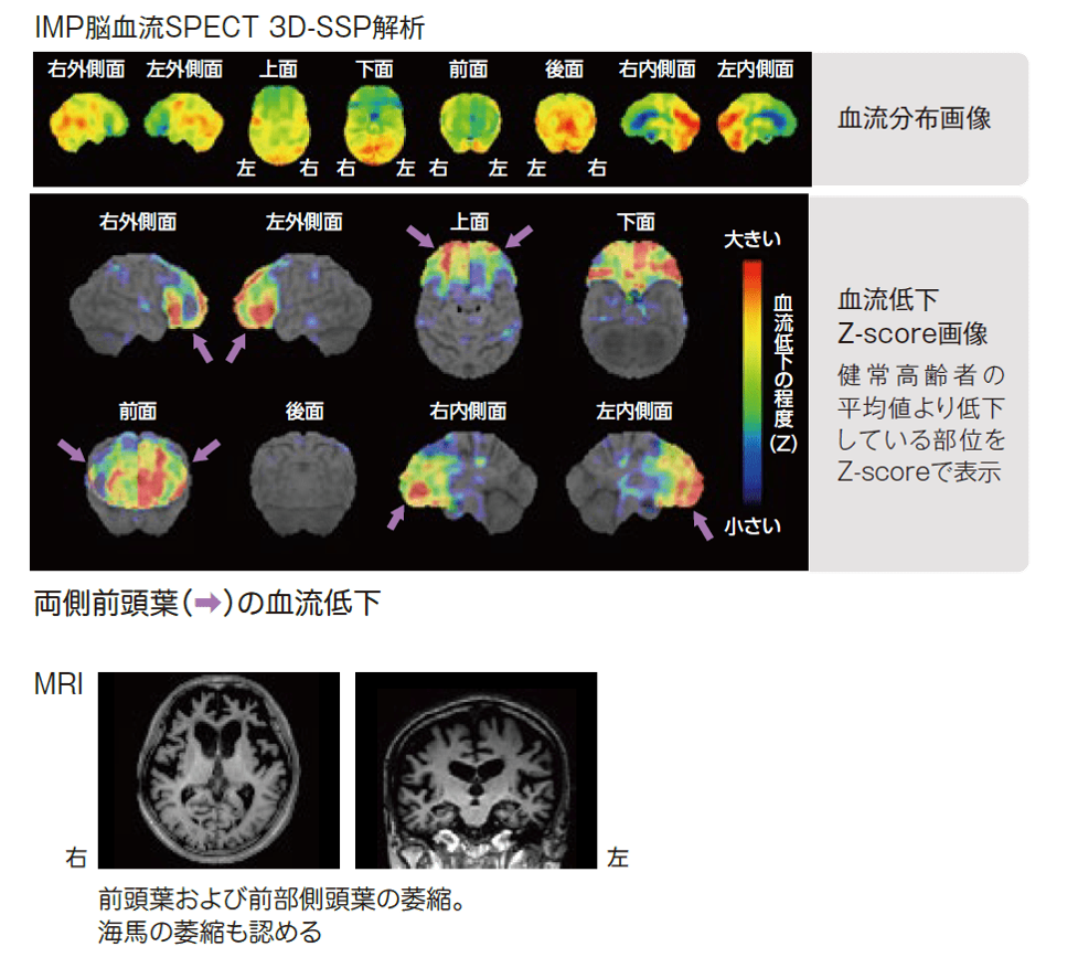 vFTD画像　IMP脳血流SPECT 3DSSP解析 MRI画像
