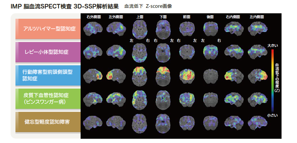 IMP脳血流SPECT 3D-SSP解析結果　血管低下 Z-score画像