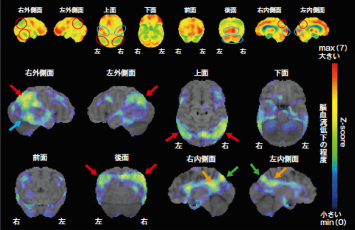 アルツハイマー型認知症(AD) 脳血流SPECT画像