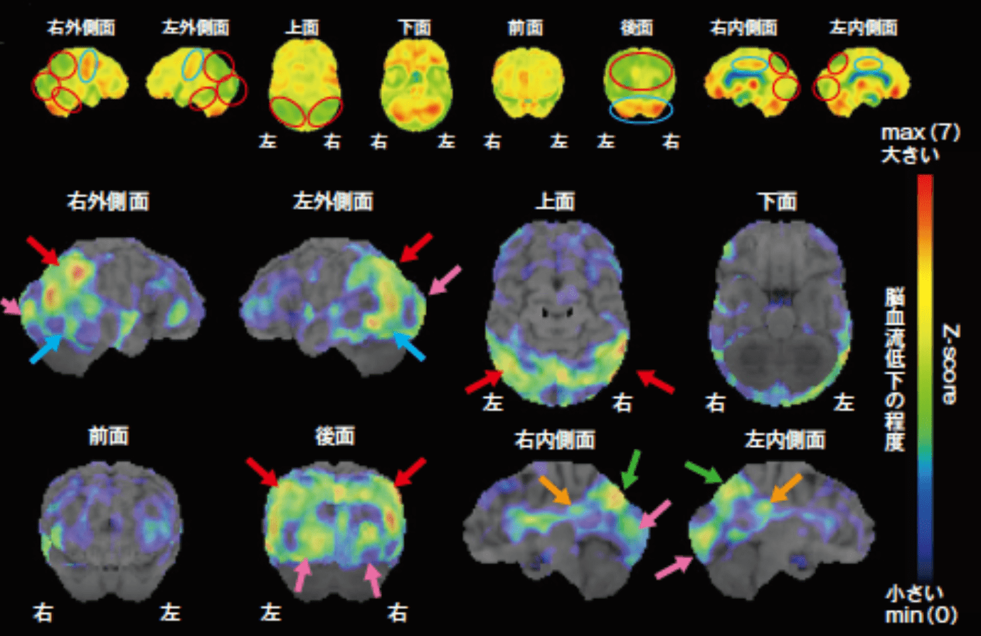 レビー小体型認知症(DLB)　脳血流SPECT画像