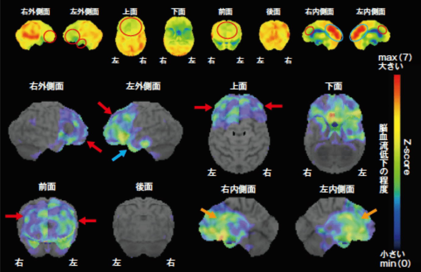 行動障害型前頭側頭型認知症(bvFTD) 脳血流SPECT画像
