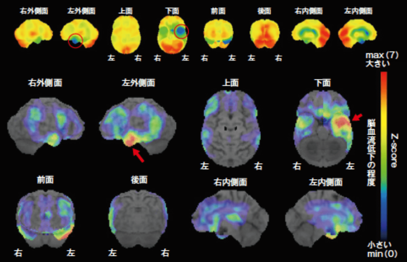 意味性認知症(SD)　脳血流SPECT画像