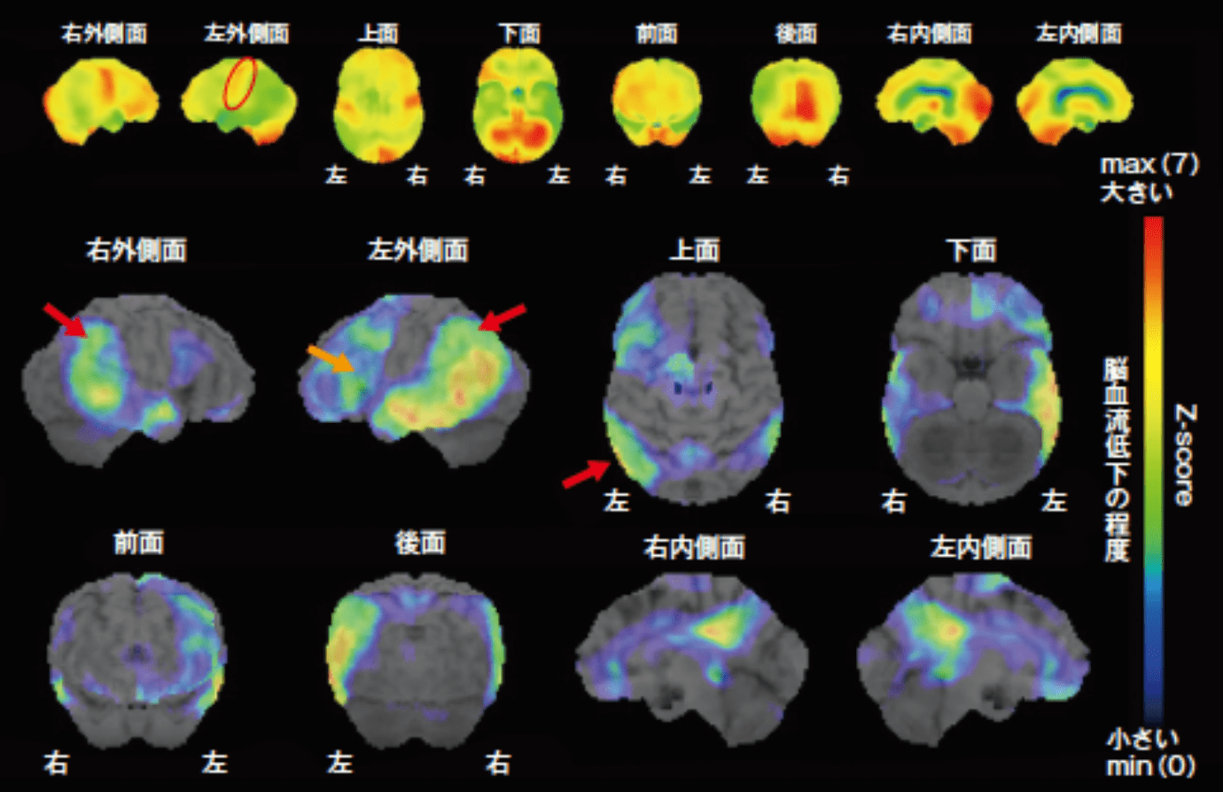 大脳皮質基底核症候群(CBS)　脳血流SPECT画像