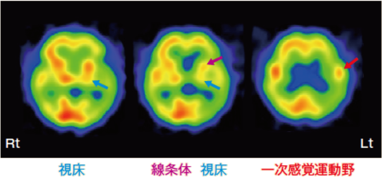 大脳皮質基底核症候群(CBS) 脳血流SPECT画像