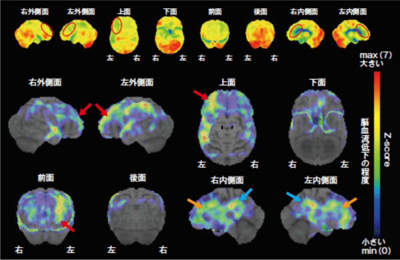 血管性認知症(ビンスワンガー病)　脳血流SPECT画像