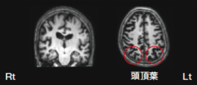MRI T1強調像